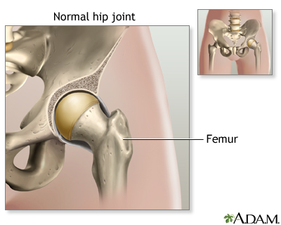 Hip joint replacement - Series Hip joint replacement - Series