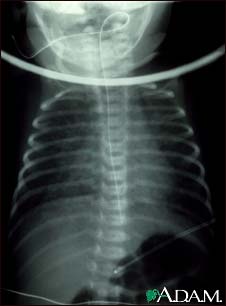 Totally anomalous pulmonary venous return - X-ray Totally anomalous pulmonary venous return - X-ray