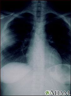 Aspergillosis - chest X-ray Aspergillosis - chest X-ray