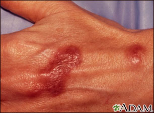 Mycobacterium marinum infection on the hand Mycobacterium marinum infection on the hand