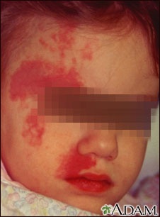 Port wine stain on a child's face Port wine stain on a child's face