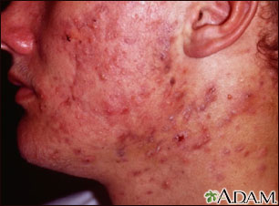 Acne - cystic on the face Acne - cystic on the face