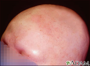 Alopecia totalis - front view of the head Alopecia totalis - front view of the head