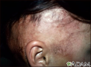 Alopecia, under treatment Alopecia, under treatment