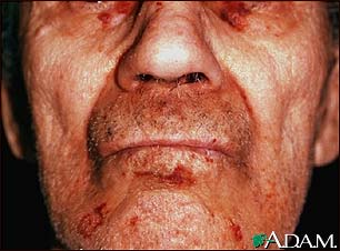 Amyloidosis of the face Amyloidosis of the face