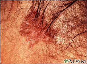 Skin cancer, basal cell carcinoma - pigmented Skin cancer, basal cell carcinoma - pigmented