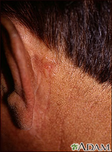 Skin cancer, basal cell carcinoma - behind ear Skin cancer, basal cell carcinoma - behind ear
