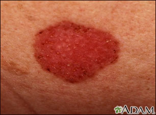 Skin cancer, basal cell carcinoma - spreading Skin cancer, basal cell carcinoma - spreading