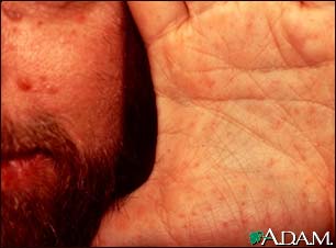 Basal cell nevus syndrome - face and hand Basal cell nevus syndrome - face and hand