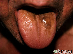 Black hairy tongue Black hairy tongue