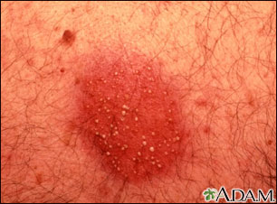Dermatitis - pustular contact Dermatitis - pustular contact