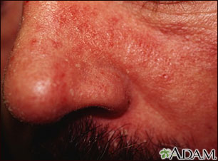 Dermatitis seborrheic - close-up Dermatitis seborrheic - close-up