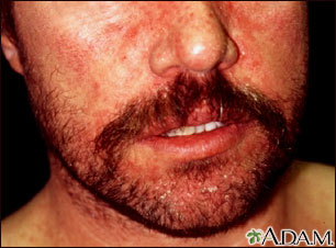 Dermatitis - seborrheic on the face Dermatitis - seborrheic on the face