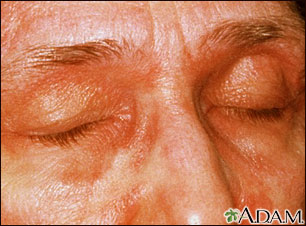 Dermatomyositis - heliotrope eyelids Dermatomyositis - heliotrope eyelids