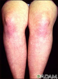 Dermatomyositis on the legs Dermatomyositis on the legs