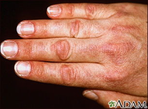 Dermatomyositis - Gottron papule Dermatomyositis - Gottron papule