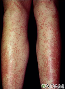 Drug rash - Tegretol Drug rash - Tegretol