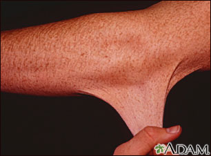 Ehlers-Danlos, hyperelasticity of the skin Ehlers-Danlos, hyperelasticity of the skin