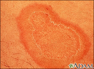 Erythema annulare centrifugum - close-up Erythema annulare centrifugum - close-up