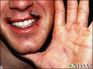 Erythema multiforme on the hand