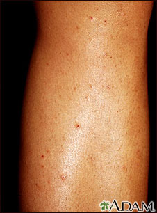 Folliculitis on the leg Folliculitis on the leg
