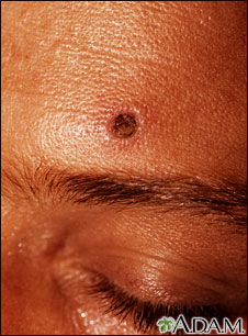 Histoplasmosis, disseminated in HIV patient Histoplasmosis, disseminated in HIV patient