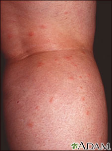 Insect bites on the legs Insect bites on the legs