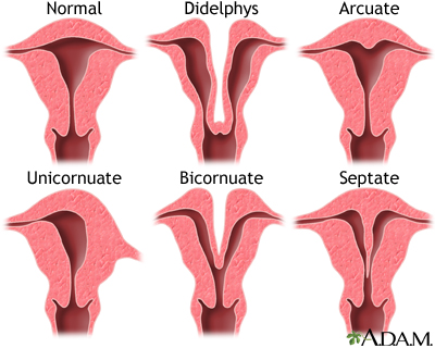 Congenital uterine anomalies Congenital uterine anomalies