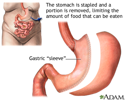 Gastric sleeve procedure Gastric sleeve procedure