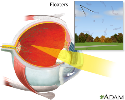 Eye floaters Eye floaters