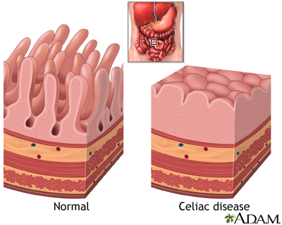 Celiac disease Celiac disease