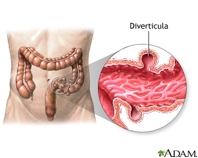 Diverticula Diverticula