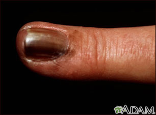 Skin cancer, melanoma on the fingernail Skin cancer, melanoma on the fingernail