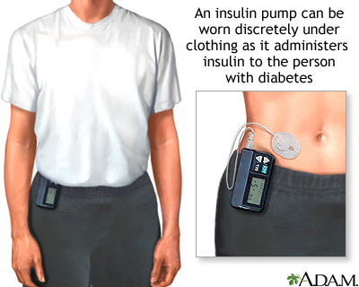 Insulin pump Insulin pump