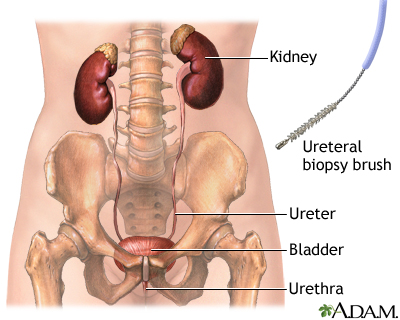 Ureteral biopsy Ureteral biopsy