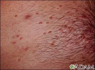 Molluscum on the chest Molluscum on the chest