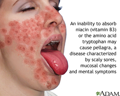 Vitamin B3 deficit Vitamin B3 deficit