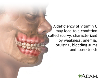Vitamin C deficit Vitamin C deficit