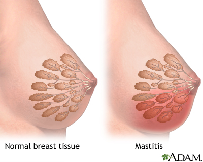 Mastitis Mastitis