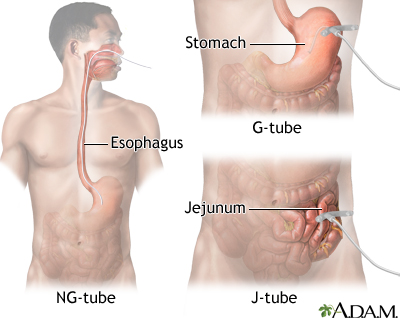 Tube feeding Tube feeding