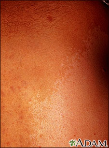 Neurofibromatosis - giant cafe-au-lait spot Neurofibromatosis - giant cafe-au-lait spot