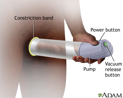 Vacuum erectile devices Vacuum erectile devices