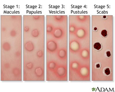 Mpox rash Mpox rash