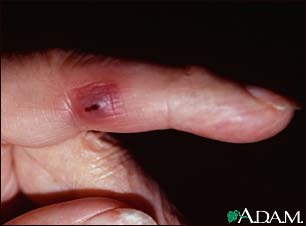 Janeway lesion on the finger Janeway lesion on the finger