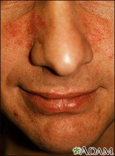 Rosacea Rosacea