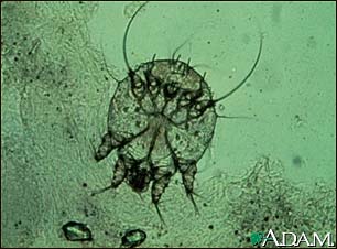 Scabies mite - photomicrograph Scabies mite - photomicrograph