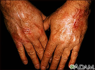 Skin cancer - squamous cell on the hands Skin cancer - squamous cell on the hands