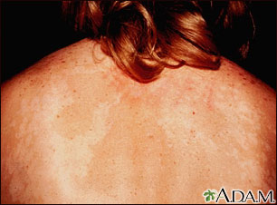 Tinea versicolor on the back Tinea versicolor on the back