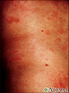 Hives (urticaria) on the trunk Hives (urticaria) on the trunk