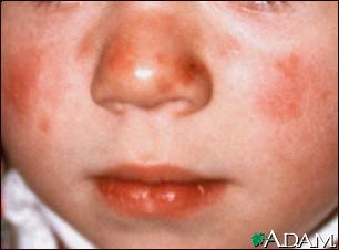 Lupus - discoid on a child's face Lupus - discoid on a child's face